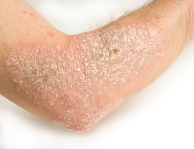 Eksim (Dermatitis) Penyakit Kulit Yang Menyebalkan 1